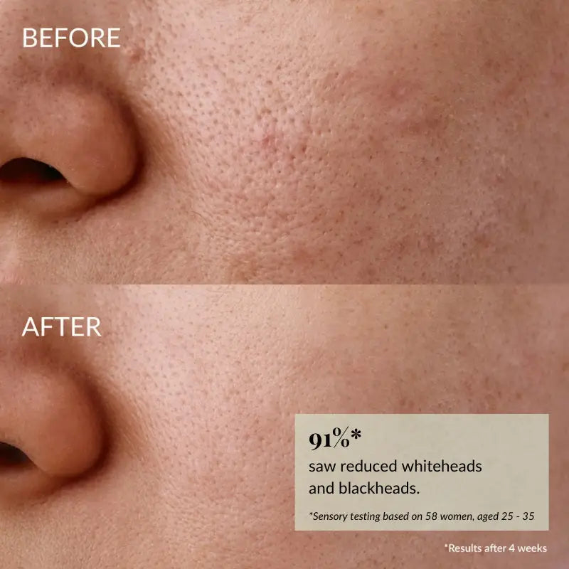 IREN Shizen Glow-Getter Renewal Serum 20ml – Exfoliating facial serum for enlarged pores, blackheads, and dull skin